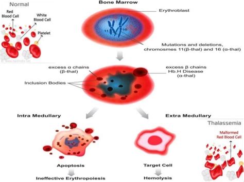 Hemoglobinopathies