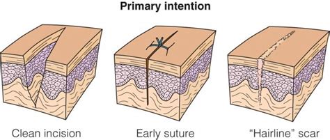 Get Me Into Vet School – rn-students-unite: First intention wound edges...