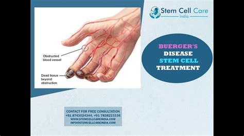 Stem cell Hospital For Buerger's Disease | Best Treatment For Buerger's Disease In Delhi | - YouTube