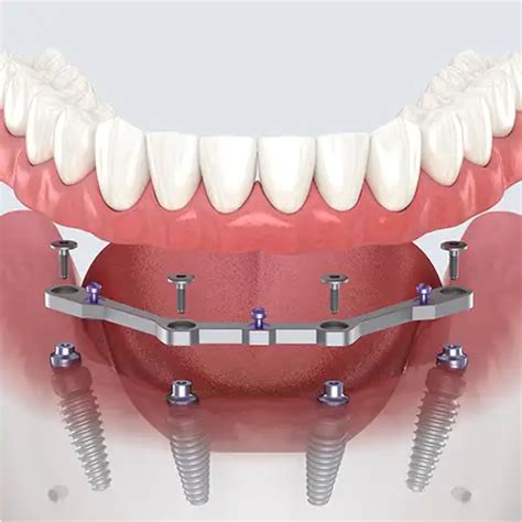 Denture Implants Near Me - Danforth | Toronto