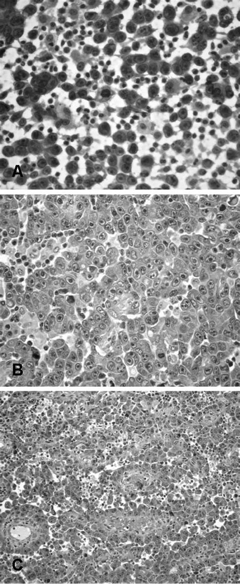 A Fine-needle cytology of the axillary lump-highly cellular smear of... | Download Scientific ...