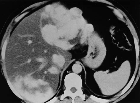 Icd 10 Code For Hemangioma Liver