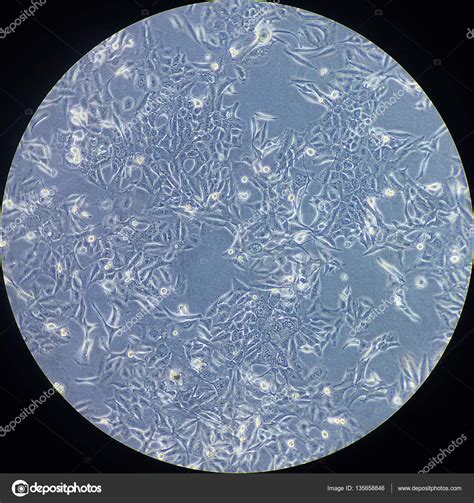 Lung Cancer Cells Under Microscope - Micropedia