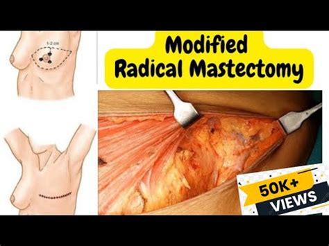 Modified Radical Mastectomy • Video • MEDtube.net