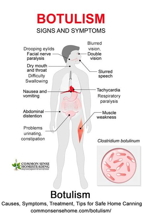 Botulism – Causes, Symptoms, Treatment, Tips for Safe Home Canning ...