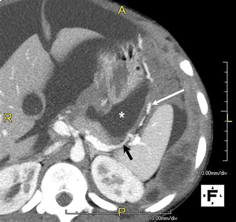 Pancreas: Peritoneal Reflections, Ligamentous Connections, and Pathways ...