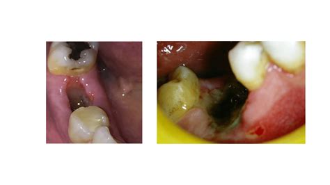 Dry Socket: The Most Common Complication After Tooth Extraction
