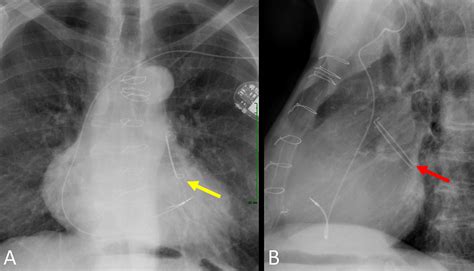 Amulet Left Atrial Appendage Closure Device