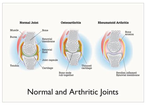 Osteoarthritis and Rheumatoid ­Arthritis 2012: Pathophysiology ...