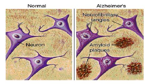 A Promising Cure for Alzheimer’s Disease? – Columbia Science Review