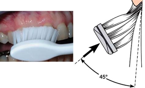 Toothbrushing Methods, Indications, and Precautions Flashcards | Quizlet