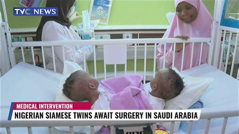 Nigerian Siamese Twins Await Surgery to Separate them in Saudi Arabia - YouTube