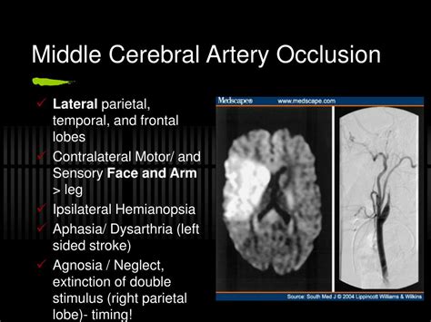 Posterior Cerebral Artery Occlusion