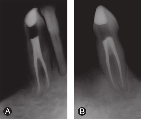 Final radiographs. A: Mandibular right canine; B: Mandibular left ...