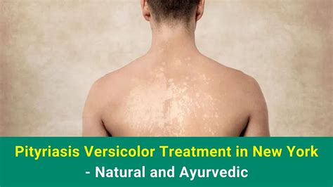 Pityriasis Versicolor Treatment in New York - Natural and Ayurvedic