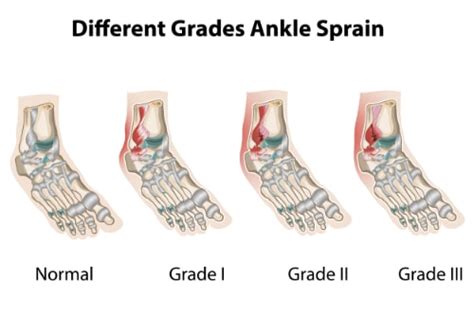 Ankle Ligament Sprains & Tears - Masnad Health Clinic