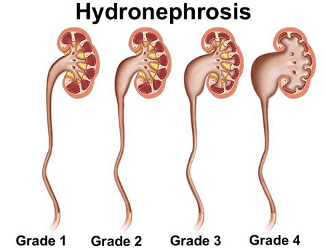 Hydronephrosis causes, symptoms, grading, diagnosis and treatment