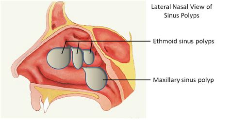 Nasal Polyp (Nose Polyps) - Dr. Jonathan Harounian