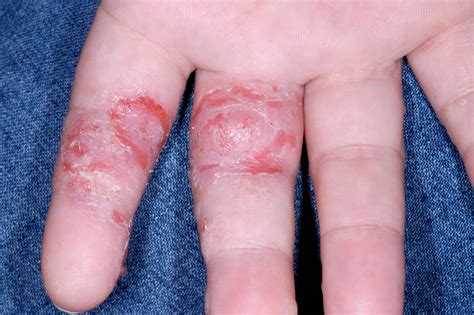 Pompholyx (dyshidrotic eczema) - NHS