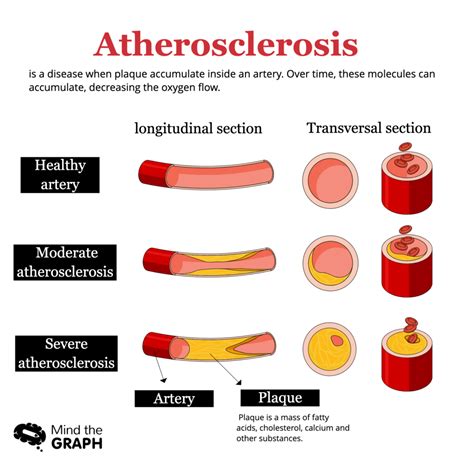 Understanding atherosclerosis through medical illustrations - Mind the Graph Blog