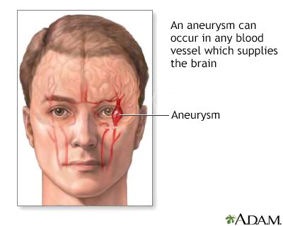 Aneurysm in the brain