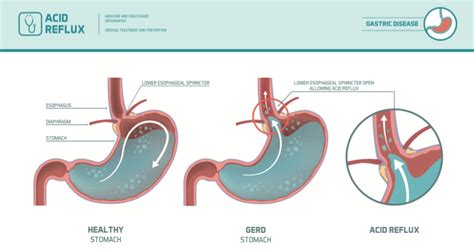 Barrett's Esophagus Fort Worth & North Richland Hills, Texas | Complication of GERD ...