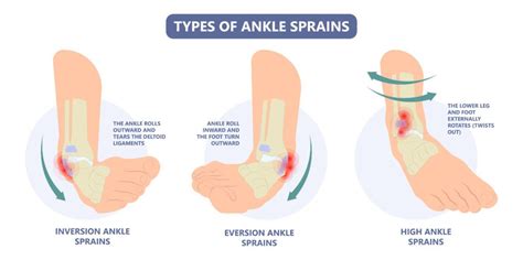 Ankle Ligament Damage - Causes & Best Treatment Options in 2024