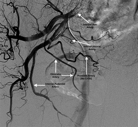 Crossing Obturator Sign: Angiographic Feature to Aid Prostatic Artery Identification - Journal ...