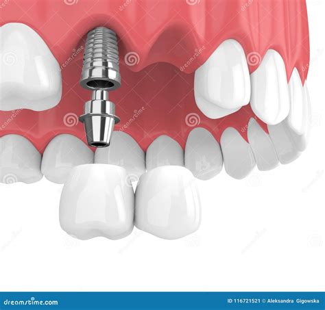 Anterior Cantilever Bridge