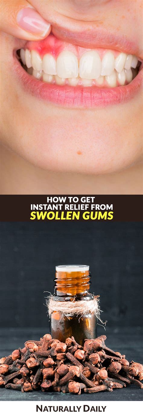 11 Home Remedies for Swollen Gums for Instant Relief| Swollen gums are ...