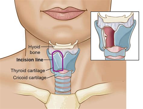 Total or partial laryngectomy procedure, complications, risks & recovery