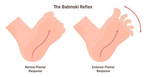 Normal Plantar Reflex