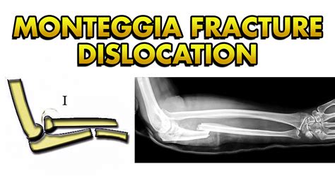 Monteggia Fracture Dislocation: Bado Classification, Treatment and Complications ...