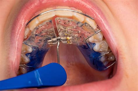 What a Palatal Expander Is & How They Work | Greater Vancouver Orthodontist