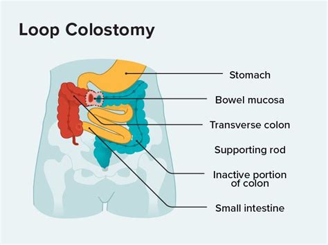 Colostomy Procedure Steps