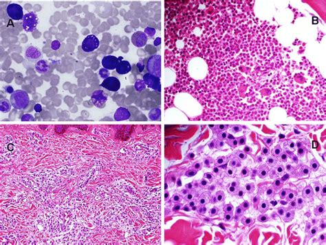 Mast cell infiltration in bone marrow and spleen from patient 2. (A ...