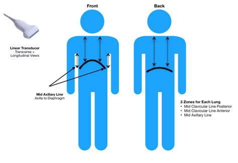 PEM Pearls: Pediatric Lung Ultrasound for Diagnosing Pneumonia | The Wave of the Future