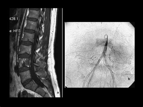 a. Sagittal MR imaging of the lumbar spine of a patient with hemangioma... | Download Scientific ...