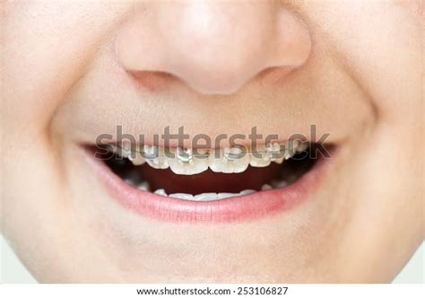 Teenage Boy Showing His Braces Stock Photo 253106827 | Shutterstock