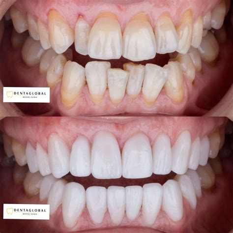 Before-After Pictures | DENTAGLOBAL. Dental Implants, Cosmetic Dentistry, Teeth Whitening ...