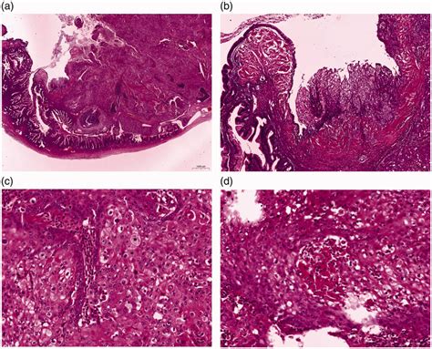 Microscopic findings in the left ovary. (a) A mucinous borderline tumor ...