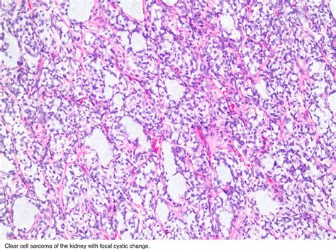 Pathology Outlines - Clear cell sarcoma