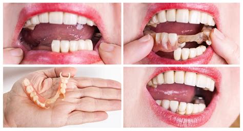 Flexible Partial Dentures 101: The Basics