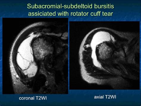 Subdeltoid Bursitis Mri