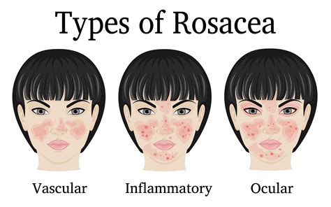 Rosacea - Advanced Skin and Laser Center