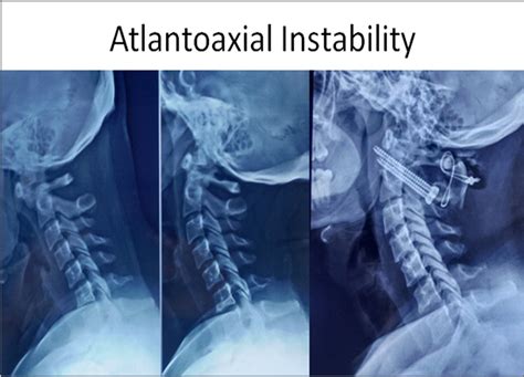 Atlantoaxial Instability