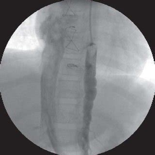 -Hemiazygos vein catheter showing contrast of its drainage to inferior... | Download Scientific ...