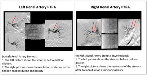 Renal Artery Stenosis Treatment Symptoms And More