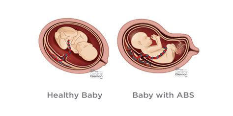 Amniotic Band Syndrome Diagnosis & Treatment | Cardinal Glennon