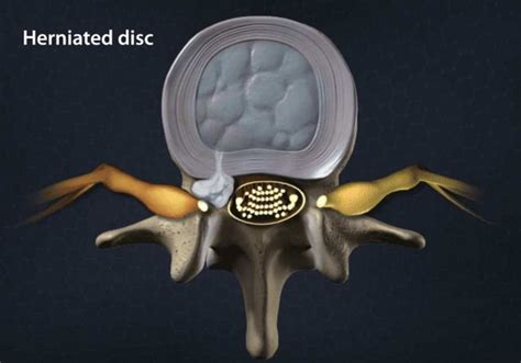 Herniated Nucleus Pulposus - Symptoms & Treatments | Florida Surgery